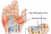 Đứt dây thần kinh giữa