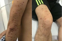 Tưởng mụn ngoài da hóa ra u vàng khắp người