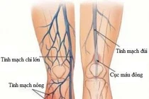 Biến chứng tắc mạch hậu COVID-19
