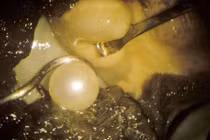 Ngọc trai thiên nhiên cực hiếm