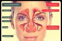 Viêm xoang trước cấp