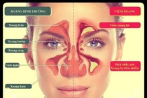 Viêm xoang trước cấp