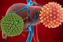 CDC Mỹ điều tra 109 trường hợp viêm gan nặng ở trẻ em