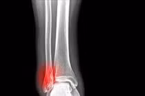 Liệt vì đắp lá khi bị vỡ xương chày 