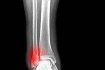 Liệt vì đắp lá khi bị vỡ xương chày 