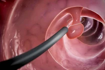 Polyp đại tràng khi nào cần cắt bỏ?