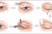 Xử lý sụp mi mắt ở người già