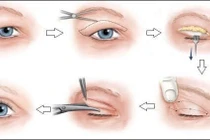 Xử lý sụp mi mắt ở người già