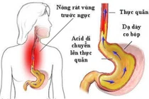  Đau lâm râm từ bụng có phải trào ngược?