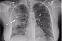 Tổn thương trên da… báo hiệu bệnh phổi