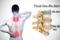 Nguyên nhân gây đau do thoái hóa đĩa đệm cột sống