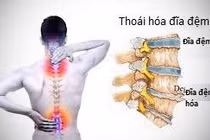 Nguyên nhân gây đau do thoái hóa đĩa đệm cột sống