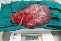 Mổ lấy thai và cắt khối u nhầy buồng trứng nặng 4,7kg