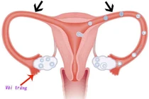 Tắc ống dẫn trứng, tinh trùng yếu có thể có con