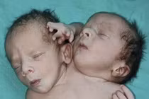 Ấn Độ: Trẻ sinh ra có hai đầu 