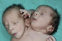 Ấn Độ: Trẻ sinh ra có hai đầu 