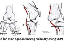 Tổn thương lại dây chằng chéo