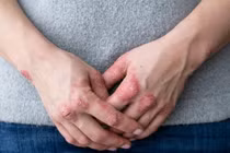 Bệnh vảy nến: Nguyên nhân và cách cải thiện tại nhà