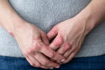 Bệnh vảy nến: Nguyên nhân và cách cải thiện tại nhà