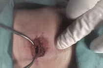 Lưỡi cưa mài bị gãy, cắt đứt khí quản bé trai 8 tuổi