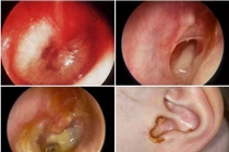  Viêm tai giữa ăn vào xương