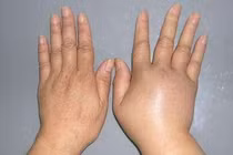 Ngất xỉu vì tự ý dùng thuốc lợi tiểu