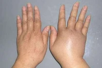 Ngất xỉu vì tự ý dùng thuốc lợi tiểu