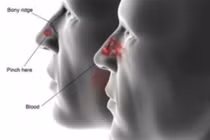 U xơ vòm mũi họng ở nam giới trẻ tuổi: Lành tính nhưng... dễ tử vong