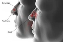 U xơ vòm mũi họng ở nam giới trẻ tuổi: Lành tính nhưng... dễ tử vong