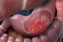 Chế cao dán giảm đau cho người ung thư dạ dày