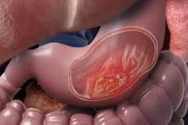 Chế cao dán giảm đau cho người ung thư dạ dày