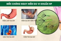 Điểm mặt nguy cơ cao gây ung thư dạ dày
