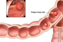 Khoảng 5-6% dân số có polyp đại tràng