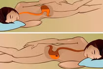 Nằm đúng để tránh trào ngược dạ dày