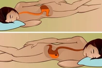 Nằm đúng để tránh trào ngược dạ dày