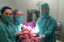 Sinh đôi cùng trứng ra đời nhờ thụ tinh ống nghiệm