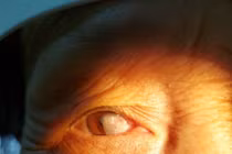  Suýt hỏng mắt vì chủ quan với mộng