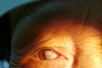  Suýt hỏng mắt vì chủ quan với mộng