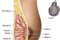 Xương và sụn trong khối u vú