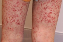 Viêm mao mạch dị ứng 