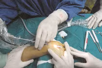 Tê tay cẩn thận hội chứng ống cổ tay gây liệt