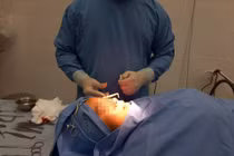 Vì sao sau nâng mũi 4 năm vẫn bị nhiễm khuẩn, thủng đầu mũi? 