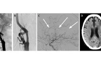 Chóng mặt do hẹp động mạch cảnh dễ tai biến