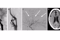 Chóng mặt do hẹp động mạch cảnh dễ tai biến