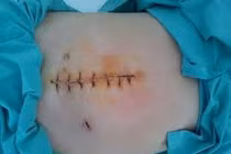 Rò và viêm dạ dày sau phẫu thuật