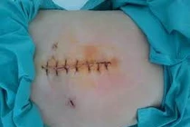 Rò và viêm dạ dày sau phẫu thuật