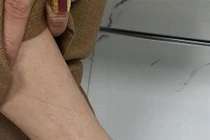 Chữa gút theo quảng cáo trên mạng, bệnh nặng thêm 