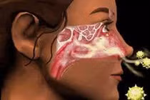 Kích thích huyệt trị viêm mũi cấp