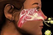 Kích thích huyệt trị viêm mũi cấp