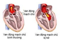 Trẻ em hỏng van động mạch chủ là do bẩm sinh